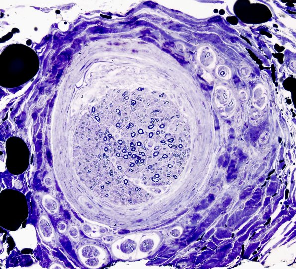 10F Neuroma, traumatic (Case 10) Plastic 1 Perifascicular