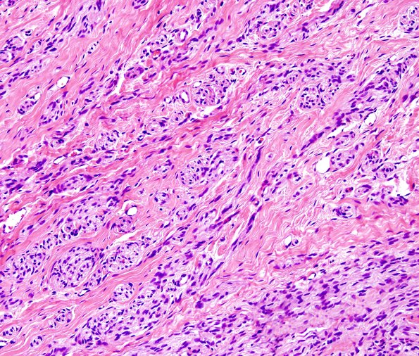 11A2 Neuroma & Ganglion (Case 11) H&E 5