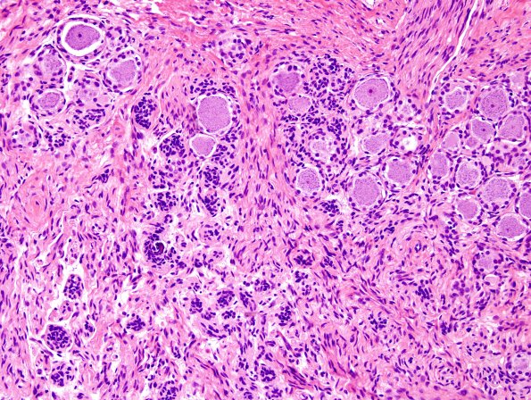 11A3 Neuroma & Ganglion (Case 11) H&E 9