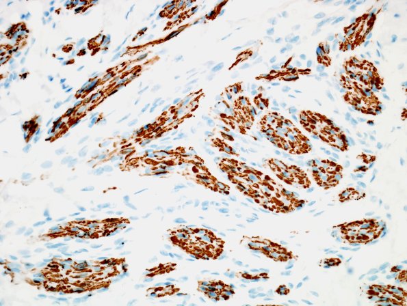 11B Neuroma & Ganglion (Case 11) NF 1