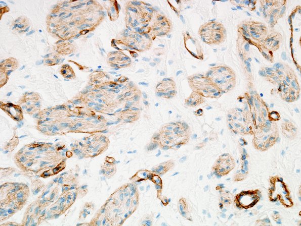 11C Neuroma & Ganglion (Case 11) Coll IV 1
