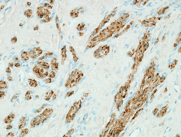 11D1 Neuroma & Ganglion (Case 11) S100 2