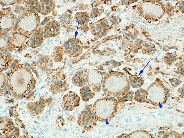 11D2 Neuroma & Ganglion (Case 11) S100 5 copy