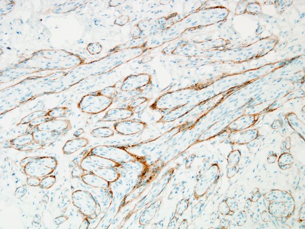 11E Neuroma & Ganglion (Case 11) EMA 2