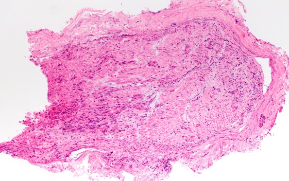 12A1 Neuroma (Case 12) H&E 10X