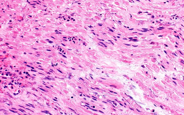 12A2 Neuroma (Case 12) H&E 40X