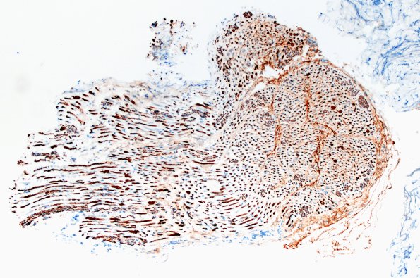 12B1 Neuroma (Case 12) NF 10X