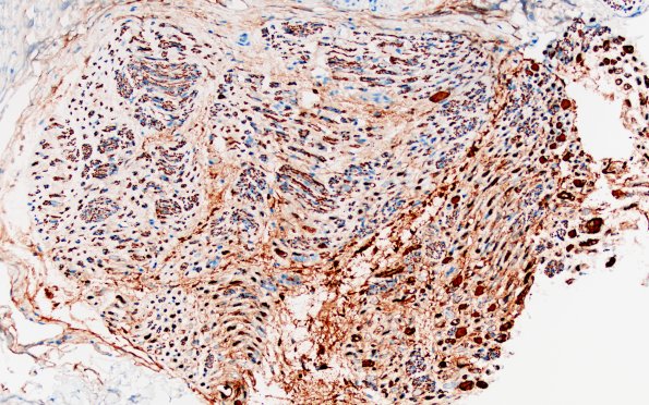 12B2 Neuroma (Case 12) NF 20X 1