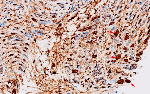 12B3 Neuroma (Case 12) NF 40X 1 copy
