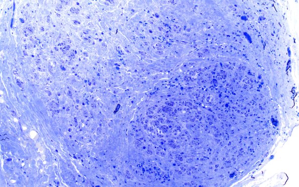 12C1 Traumatic stump (Case 12) Plastic 20X