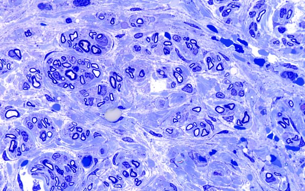 12C2 Traumatic stump (Case 12) Plastic 100X