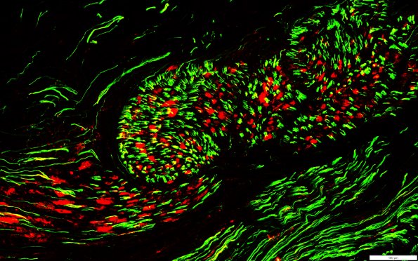12G2 (Case 12) NF(g) & GAP43(r)