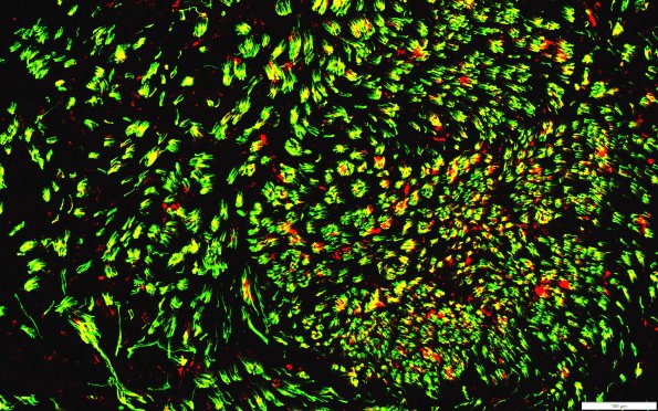 12G4 (Case 12) NF(g) & GAP43(r)