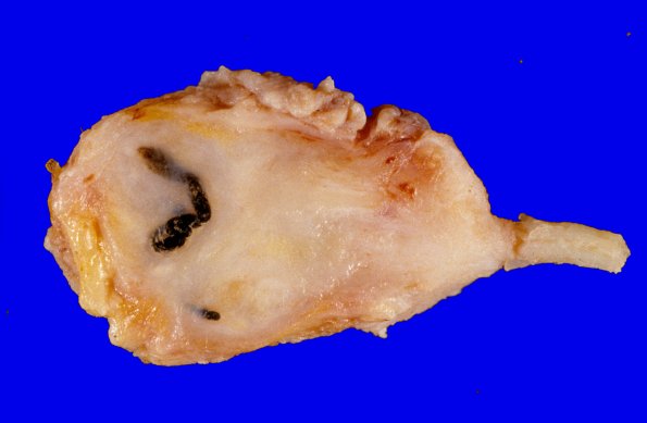 13A Neuroma, traumatic (Case 13) gross 3