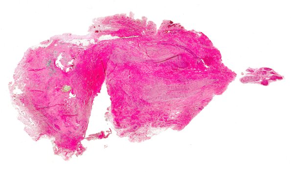 13B1 Neuroma, traumatic (Case 13) H&E WM