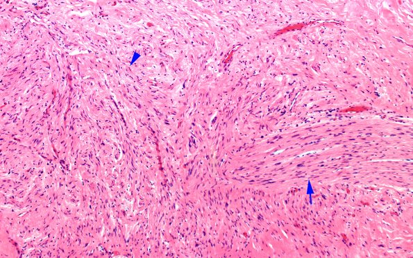 13B2 Neuroma, traumatic (Case 13) H&E stump prox 10X 2 copy