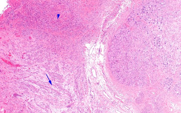 14A1 Neuroma, traumatic (Case 14) H&E near DRG 4X 1 copy