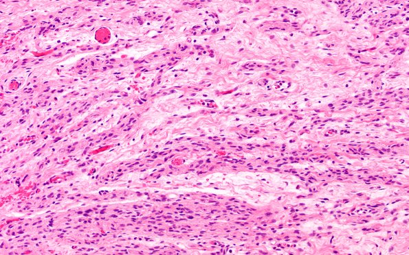 14A2 Neuroma, traumatic (Case 14) H&E near DRG 20X 1