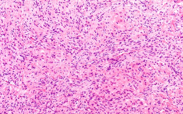 14A3 Neuroma, traumatic (Case 14) H&E near DRG 20X 2