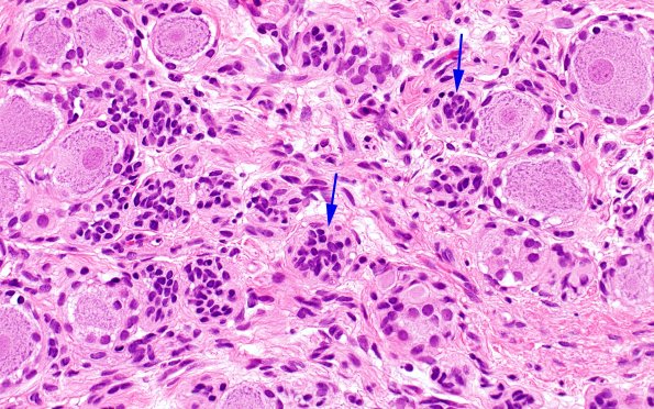 14A4 Neuroma, traumatic (Case 14) H&E near DRG 40X 1 copy