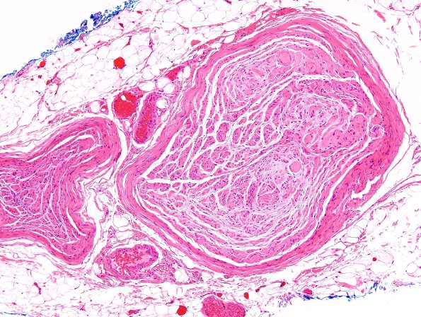 15A1 Meralgia Paresthetica (Case 15) H&E 4