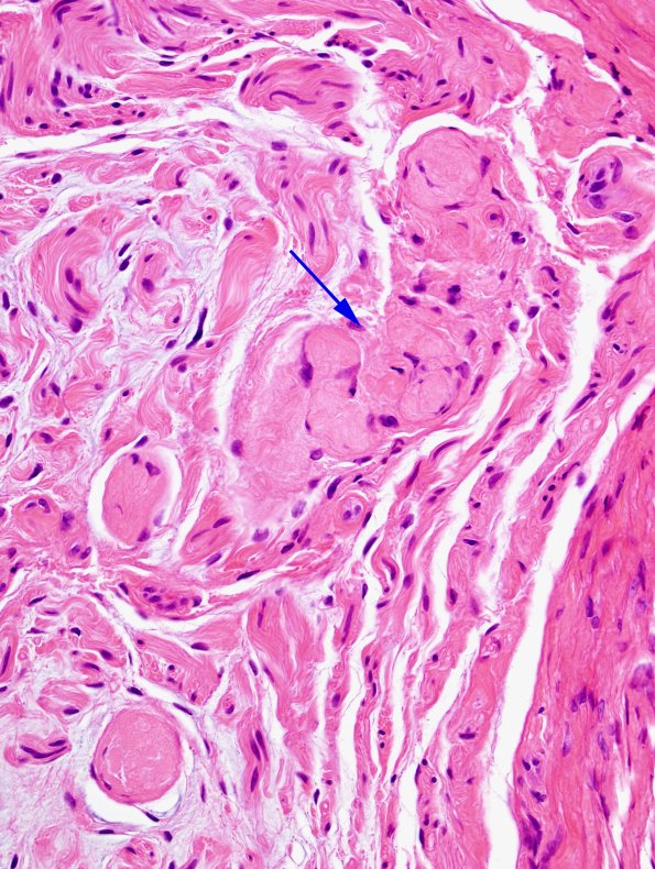 15A2 Meralgia Paresthetica (Case 15) H&E 1 copy