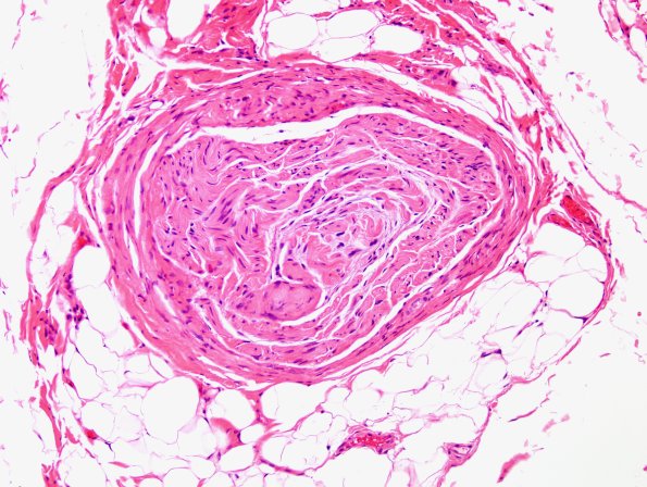 15A3 Meralgia Paresthetica (Case 15) H&E 3