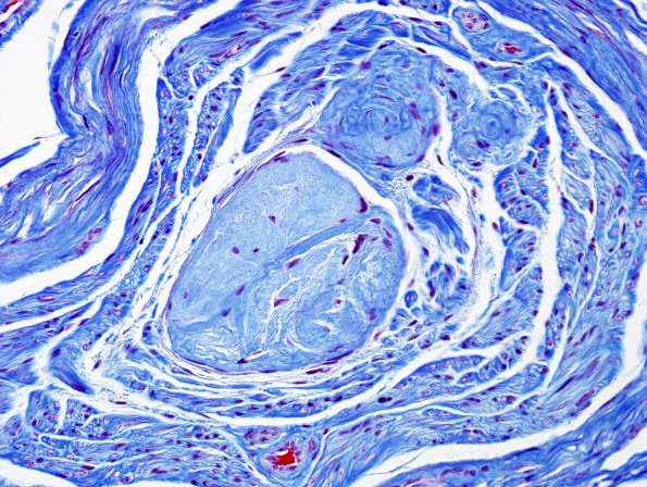 15B1 Meralgia Paresthetica (Case 15) Trichrome 1