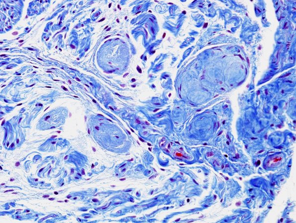15B2 Meralgia Paresthetica (Case 15) Trichrome 2