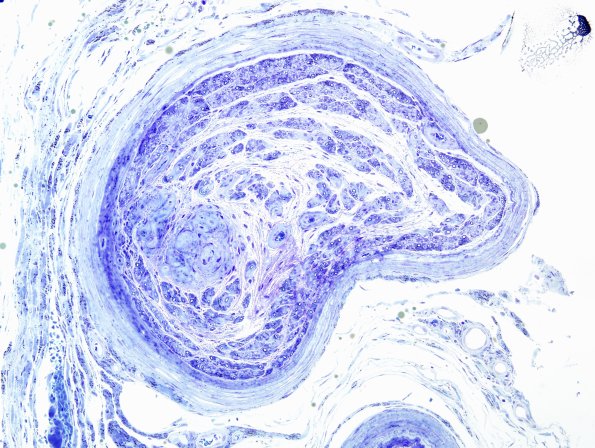 15C1 Meralgia Paresthetica (Case 15) Plastic 3