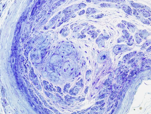 15C2 Meralgia Paresthetica (Case 15) Plastic 2