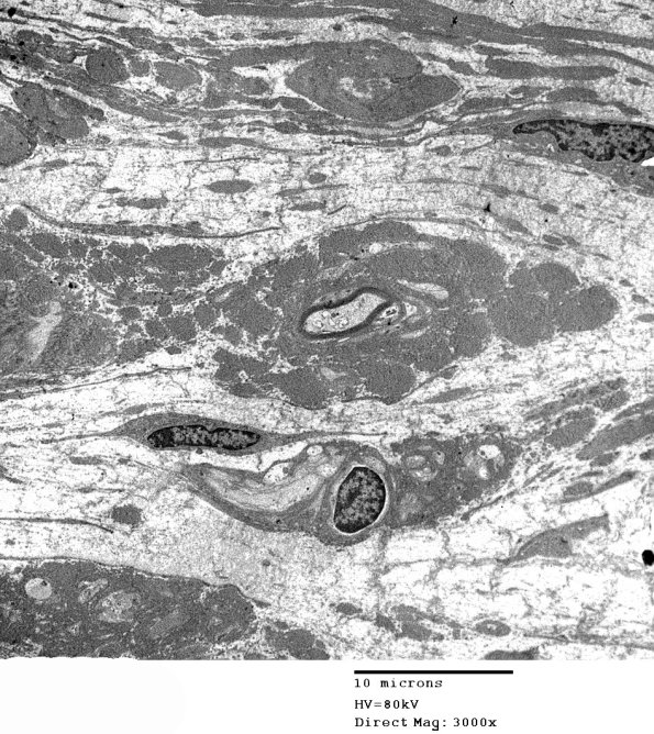 15D1 Meralgia Paresthetica (Case 15) EM 1 - Copy