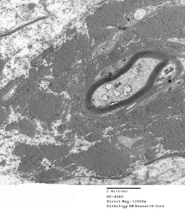 15D2 Meralgia Paresthetica (Case 15) EM 017 - Copy