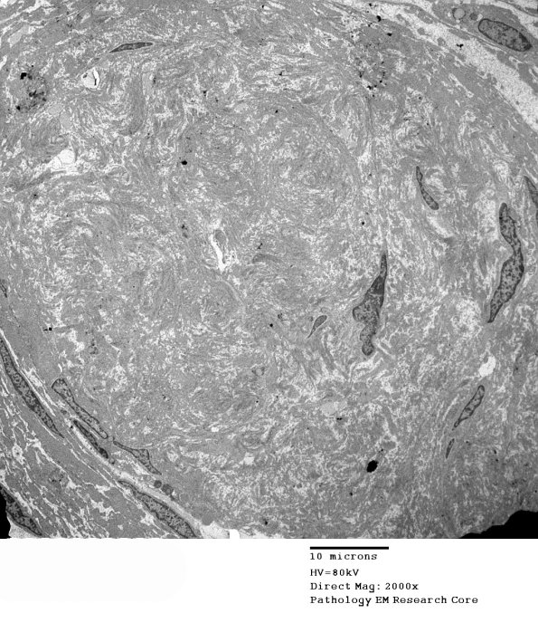 15D4 Meralgia Paresthetica (Case 15) EM 011 - Copy
