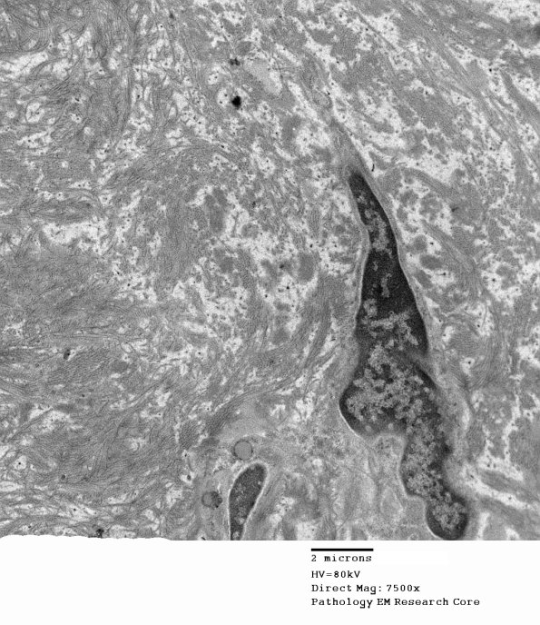 15D5 Meralgia Paresthetica (Case 15) EM 012 - Copy