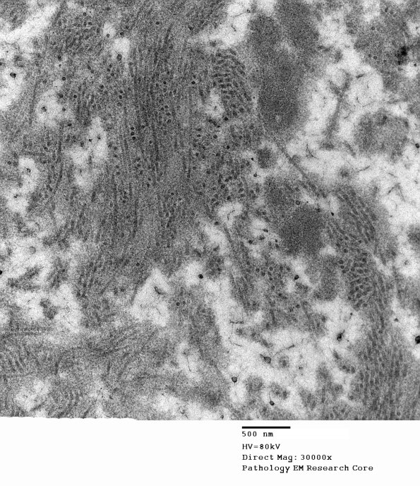 15D6 Meralgia Paresthetica (Case 15) EM 013 - Copy