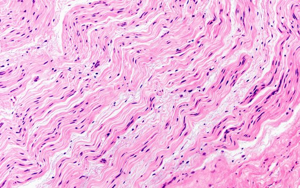 16A Fustration (Case 16) H&E 20X