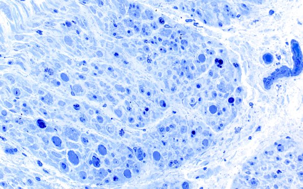 16B1 Regeneration, frustration (Case 16) Plastic 40X 2