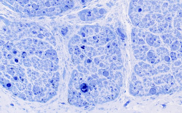 16B2 Regeneration, frustration (Case 16) Plastic 40X 3