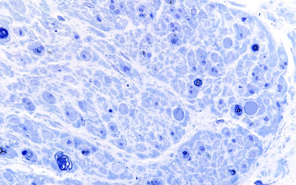 16B3 Regeneration, frustration (Case 16) Plastic 60X 1