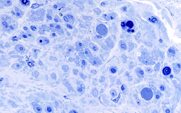 16B5 Regeneration, frustration (Case 16) Plastic 100X 2