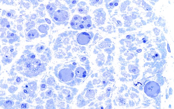 16B6 Regeneration, frustration (Case 16) Plastic 100X 1