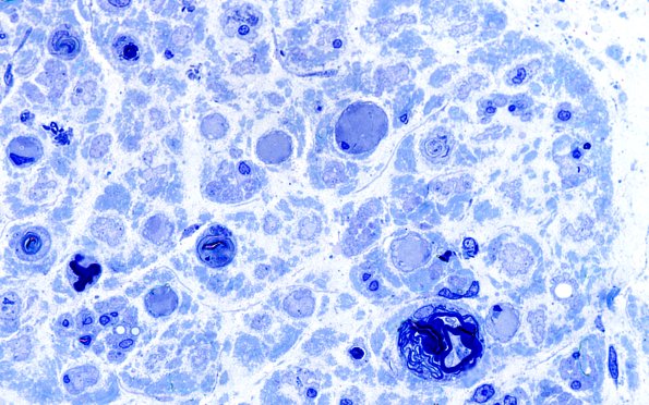 16B7 Regeneration, frustration (Case 16) Plastic 100X 2