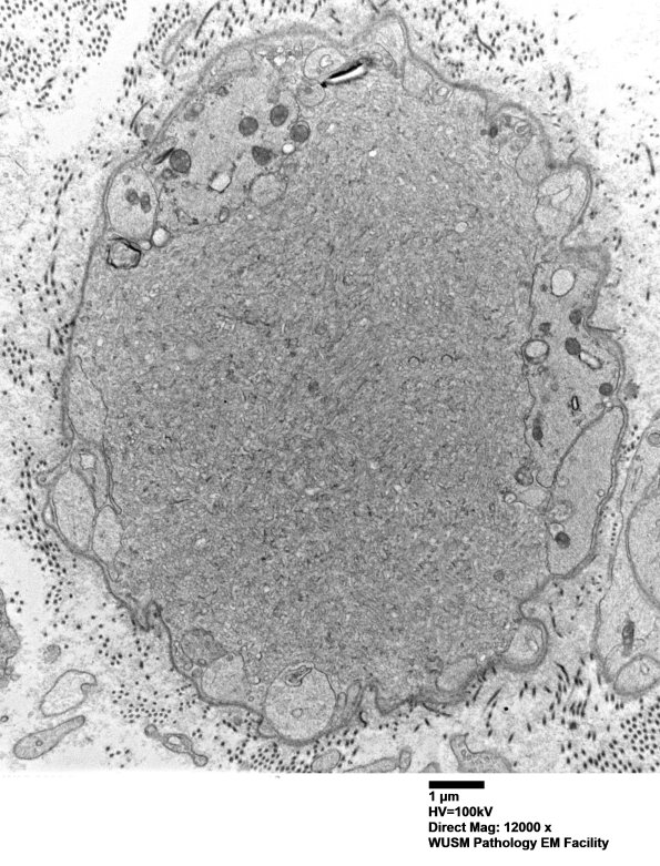 16C1 (Case 16) L PIN nerve_006 - Copy