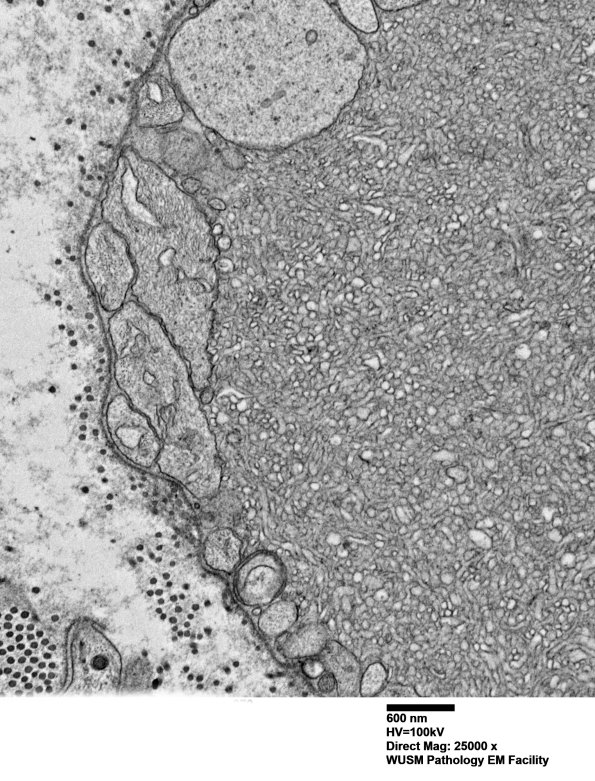 16C10 (Case 16) L PIN nerve_070 - Copy