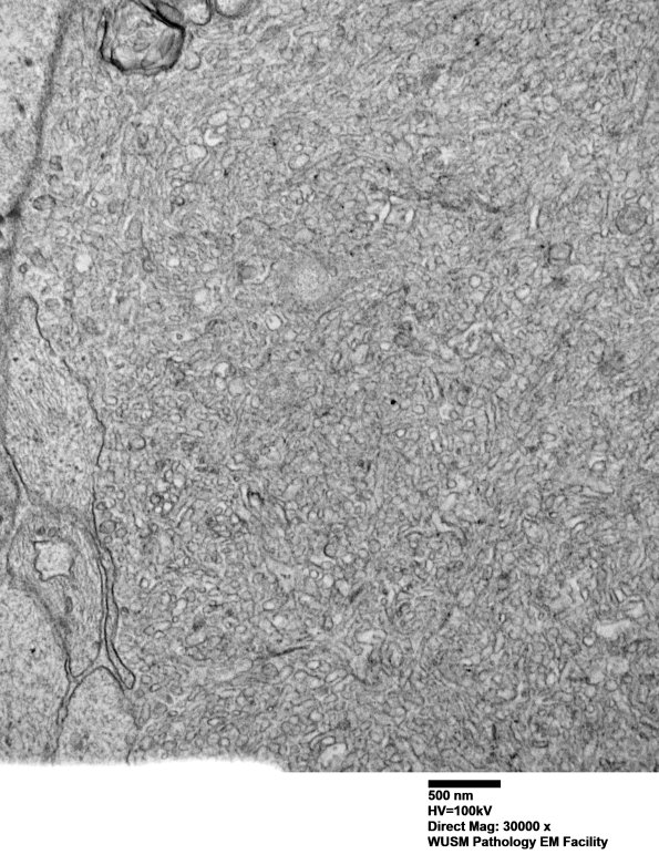 16C2 (Case 16) L PIN nerve_007 - Copy