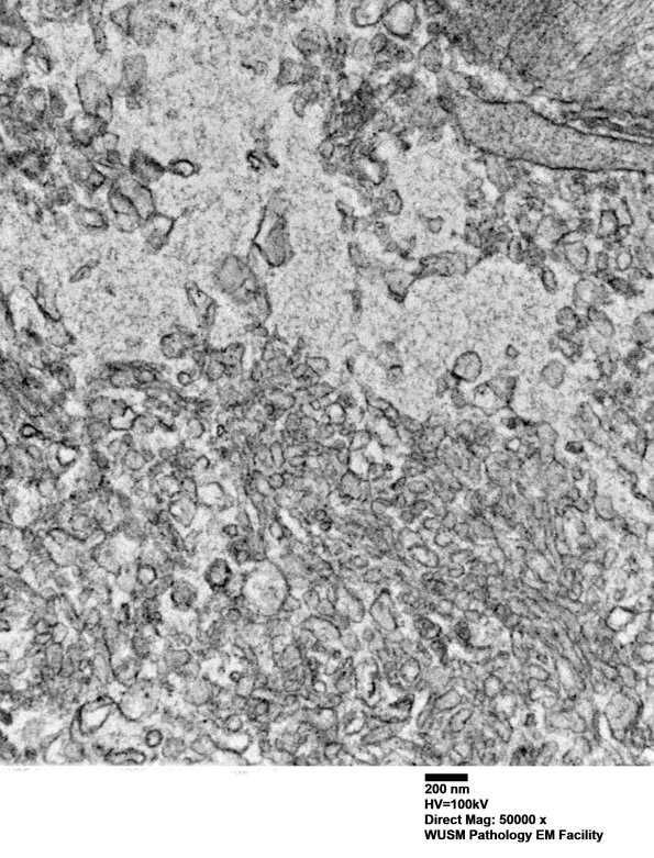 16C4 (Case 16) L PIN nerve_020 - Copy