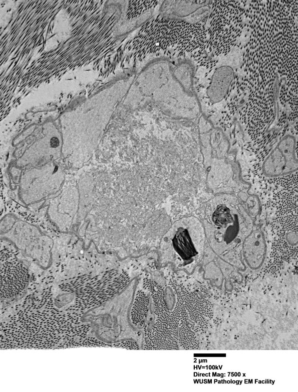 16C3 (Case 16) L PIN nerve_022 - Copy