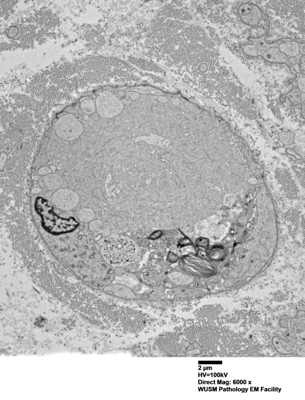 16C5 (Case 16) L PIN nerve_025 - Copy