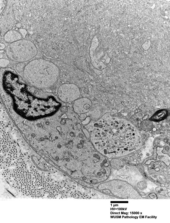 16C6 (Case 16) L PIN nerve_027 - Copy